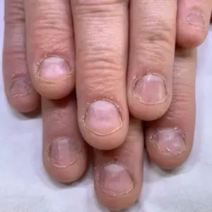 Stop Nail Biting