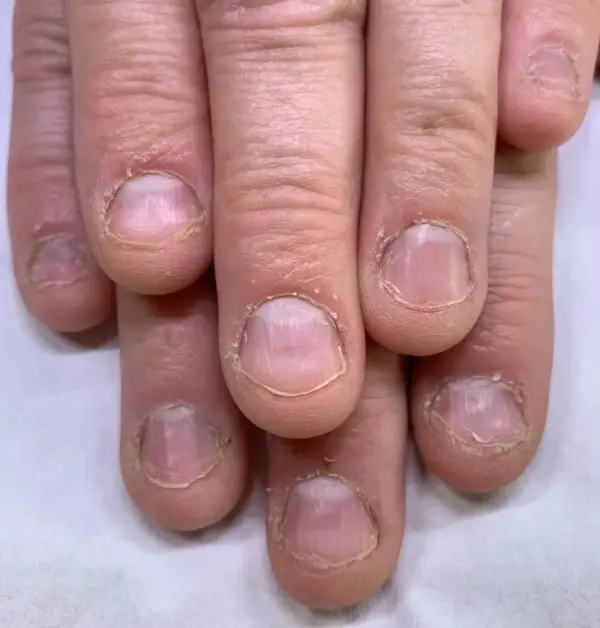 Stop Nail Biting